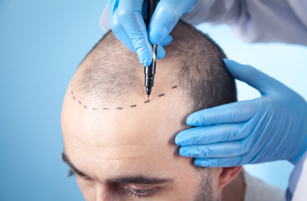 Patient Suffering From Hair Loss Consultation With Doctor Doctor Using Skin Marker 1